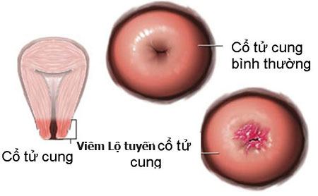 Chữa viêm lộ tuyến tử cung bằng đông y ở Hà Nội 1
